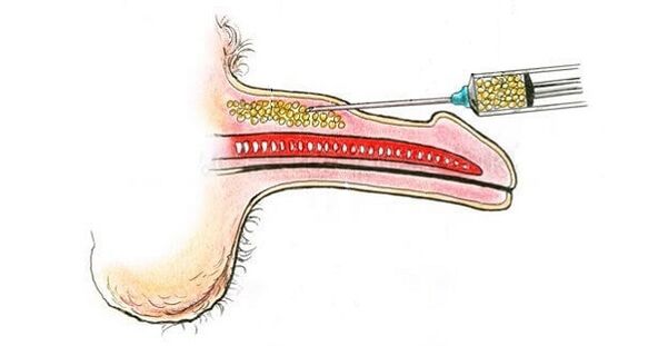 Iniezioni di acido ialuronico nel corso di un membro per aumentarlo